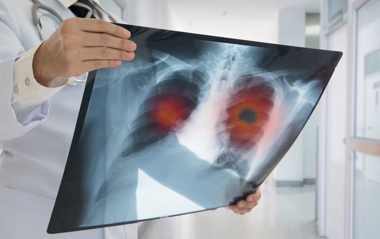 This Targeted Lung Cancer Screening Program Can Improve Health and Save Money